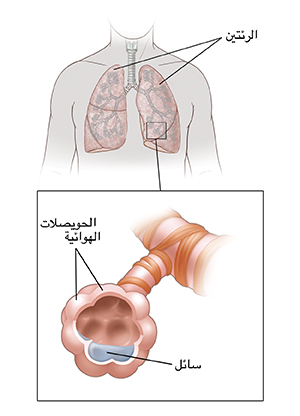 صورة أمامية للصدر تُظهر الرئتين. يُظهر الشكل الداخلي الحويصلات الهوائية مليئة بالسوائل.