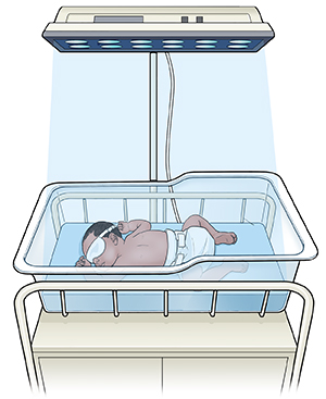 Neonato con gli occhi coperti sotto una lampada per fototerapia in una culla d’ospedale.