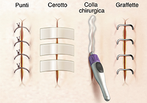 Quattro incisioni che mostrano punti di sutura, steri strip, colla chirurgica e graffette.