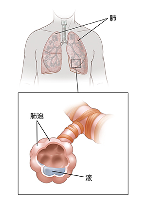 顯示肺部的胸前視圖。插圖顯示充滿液體的肺泡。