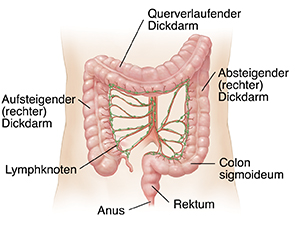 Schematische Darstellung eines Bauchs mit Arterien und Lymphknoten des Dickdarms.