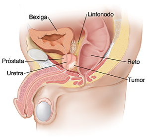 Vista lateral dos órgãos pélvicos masculinos que mostram um tumor na próstata.