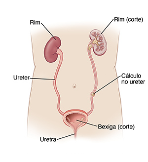 Ilustração mostrando a anatomia do sistema urinário, incluindo os rins, a bexiga, a uretra e um cálculo no ureter.
