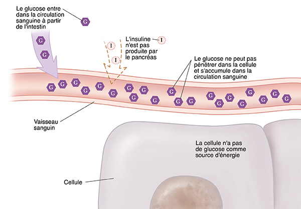 Coupe transversale en gros plan d'un vaisseau sanguin près de cellules montrant un diabète de type 1. L'insuline n'est pas produite. Le glucose ne peut pas pénétrer dans les cellules et s'accumule dans la circulation sanguine. La cellule n'a pas de glucose comme source d'énergie.