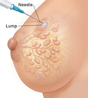 Vue latérale du sein d'une femme avec des conduits et des lobules en faible contraste, illustrant la biopsie à l'aiguille d'une masse.